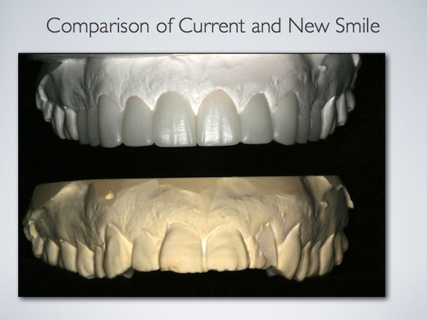 Smile design process image 6